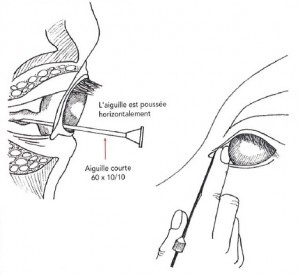 anesthésie de l'oeil- méthode rétrobulbaire
